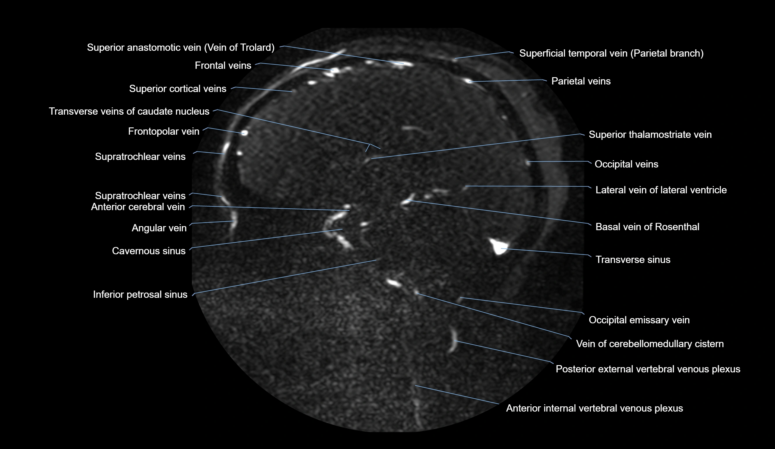 MRV brain sagittal anatomy 3T MRI images -img-01015-00038.webp